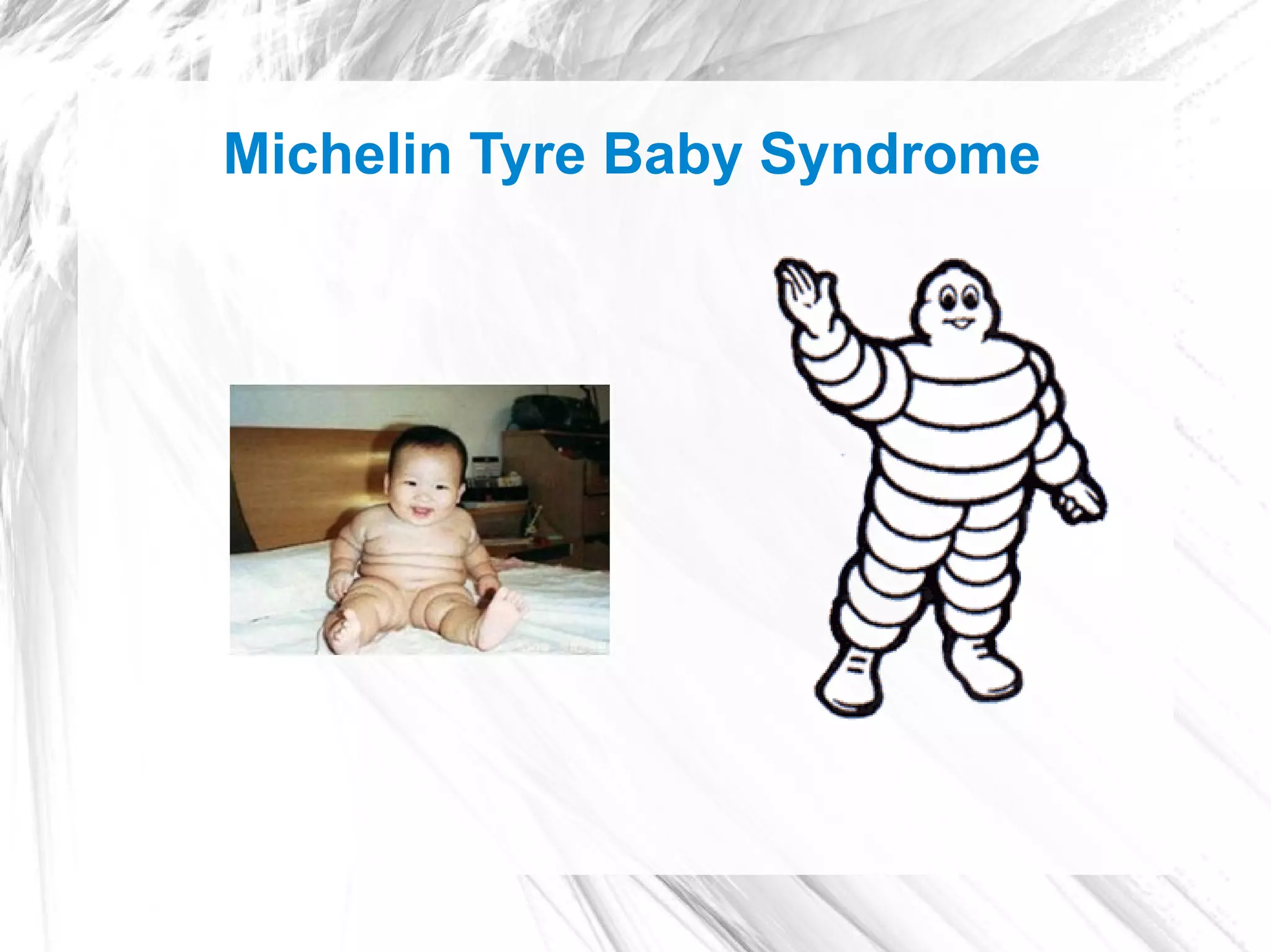 Michelin Tyre Baby Syndrome
 