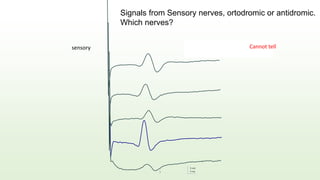 5 ms
5 mV
sensory Usually you cannot tell the origin
of sensory recordings
1
Cannot tell
Signals from Sensory nerves, ortodromic or antidromic.
Which nerves?
 