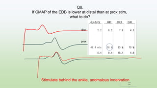 Stimulate behind the ankle, anomalous innervation
5 ms
5 mV
dist
prox
+36%
1
Q8.
If CMAP of the EDB is lower at distal than at prox stim,
what to do?
 