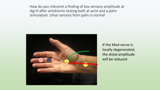 How do you interpret a finding of low sensory amplitude at
dig III after antidromic testing both at wrist and a palm
stimulation. Ulnar sensory from palm is normal
7
7
If the Med nerve is
locally degenerated,
the distal amplitude
will be reduced
 