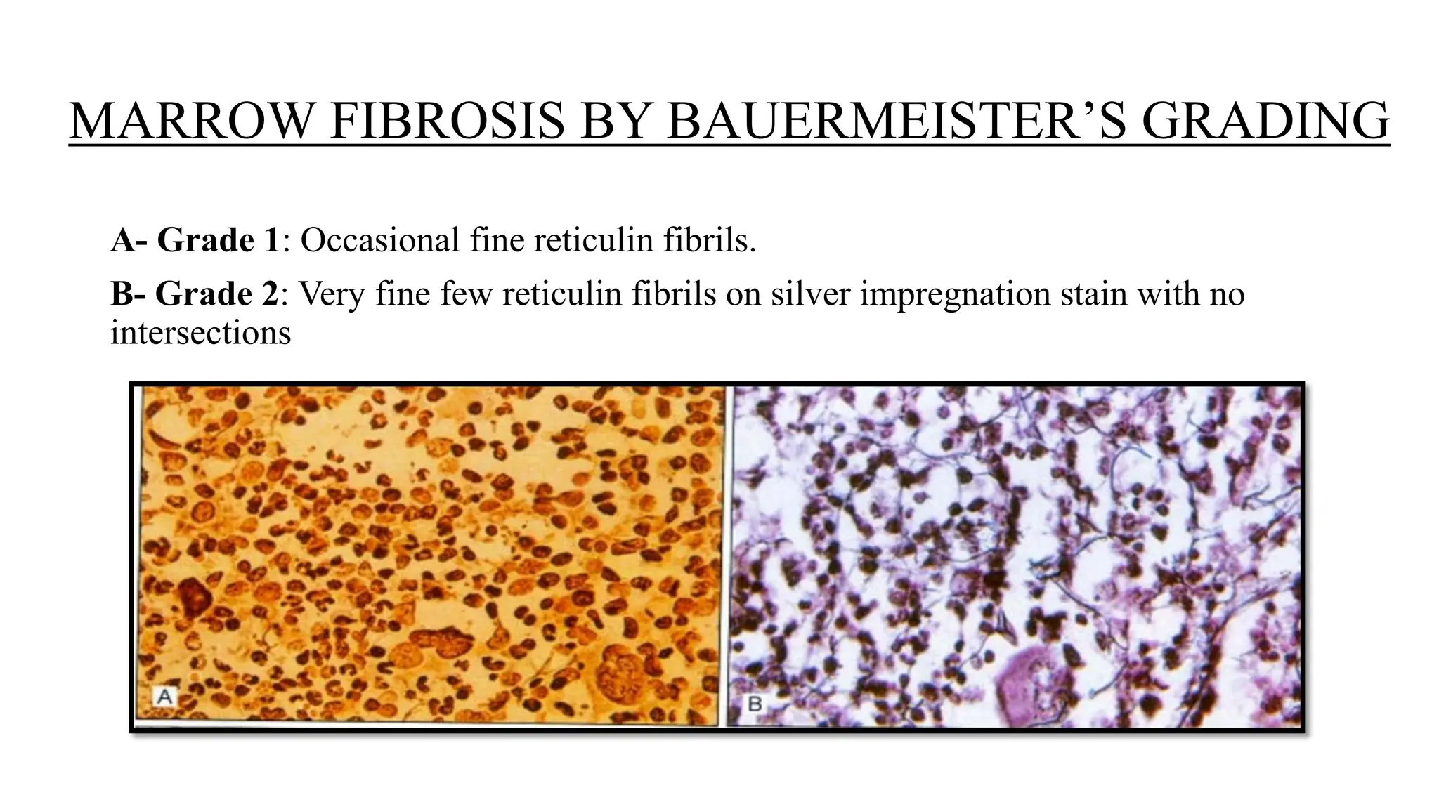 QUIZ ON BONE MARROW-MICROCYTIC + APLASTIC.pptx