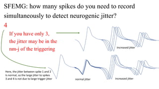 normal jitter increased jitter
Increased jitter
SFEMG: how many spikes do you need to record
simultaneously to detect neurogenic jitter?
4
If you have only 3,
the jitter may be in the
nm-j of the triggering
Here, the jitter between spike 1 and 2
Is normal, so the large jitter to spikes
3 and 4 is not due to large trigger jitter
 