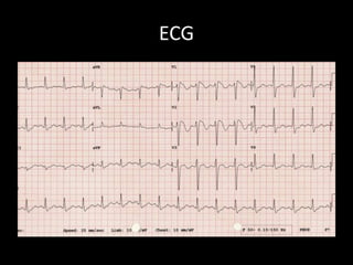 ECG
 