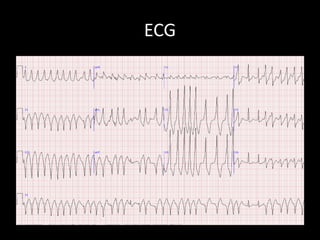 ECG
 