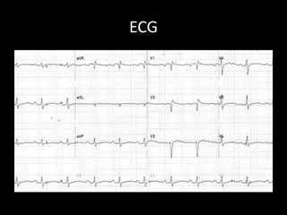 ECG
 