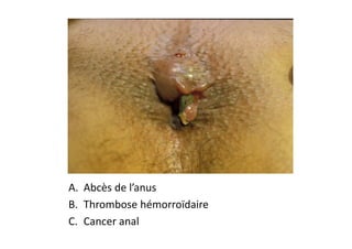 A. Abcès de l’anus
B. Thrombose hémorroïdaire
C. Cancer anal
 