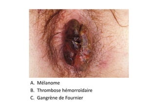 A. Mélanome
B. Thrombose hémorroïdaire
C. Gangrène de Fournier
 