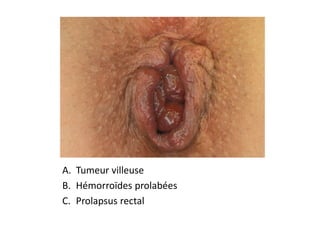 A. Tumeur villeuse
B. Hémorroïdes prolabées
C. Prolapsus rectal
 