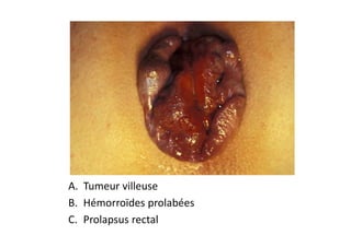 A. Tumeur villeuse
B. Hémorroïdes prolabées
C. Prolapsus rectal
 