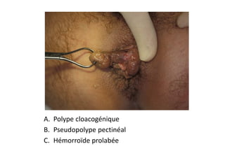 A. Polype cloacogénique
B. Pseudopolype pectinéal
C. Hémorroïde prolabée
 