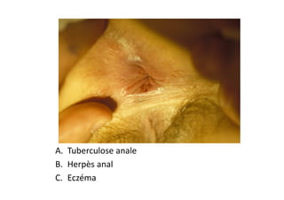 A. Tuberculose anale
B. Herpès anal
C. Eczéma
 