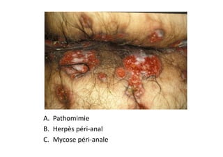 A. Pathomimie
B. Herpès péri-anal
C. Mycose péri-anale
 