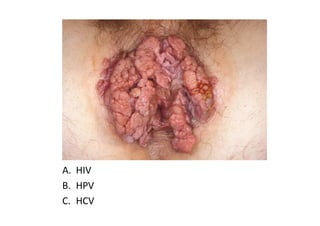 A. HIV
B. HPV
C. HCV
 