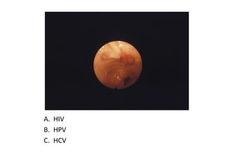 A. HIV
B. HPV
C. HCV
 