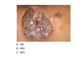 A. HIV
B. HPV
C. HCV
 