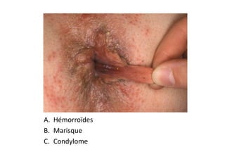 A. Hémorroïdes
B. Marisque
C. Condylome
 