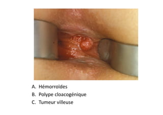 A. Hémorroïdes
B. Polype cloacogénique
C. Tumeur villeuse
 