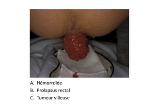 A. Hémorroïde
B. Prolapsus rectal
C. Tumeur villeuse
 