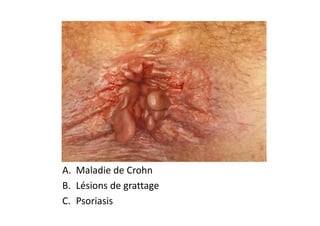 A. Maladie de Crohn
B. Lésions de grattage
C. Psoriasis
 