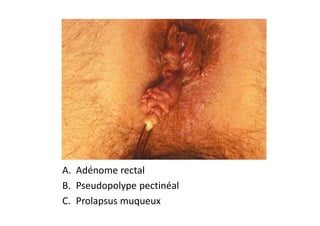 A. Adénome rectal
B. Pseudopolype pectinéal
C. Prolapsus muqueux
 