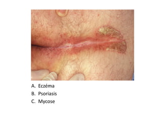 A. Eczéma
B. Psoriasis
C. Mycose
 