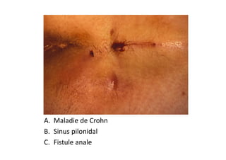 A. Maladie de Crohn
B. Sinus pilonidal
C. Fistule anale
 