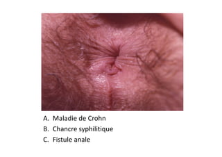 A. Maladie de Crohn
B. Chancre syphilitique
C. Fistule anale
 