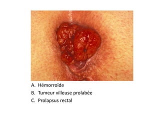 A. Hémorroïde
B. Tumeur villeuse prolabée
C. Prolapsus rectal
 
