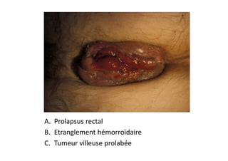 A. Prolapsus rectal
B. Etranglement hémorroïdaire
C. Tumeur villeuse prolabée
 