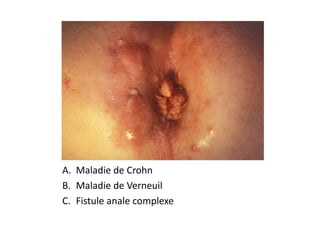 A. Maladie de Crohn
B. Maladie de Verneuil
C. Fistule anale complexe
 