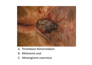 A. Thrombose hémorroïdaire
B. Mélanome anal
C. Hémangiome caverneux
 