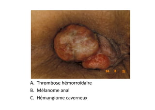 A. Thrombose hémorroïdaire
B. Mélanome anal
C. Hémangiome caverneux
 