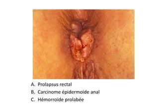 A. Prolapsus rectal
B. Carcinome épidermoïde anal
C. Hémorroïde prolabée
 