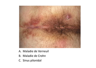 A. Maladie de Verneuil
B. Maladie de Crohn
C. Sinus pilonidal
 