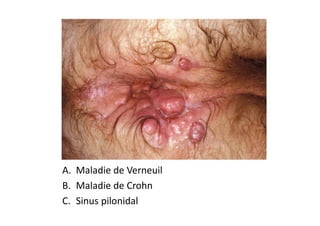 A. Maladie de Verneuil
B. Maladie de Crohn
C. Sinus pilonidal
 