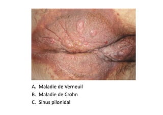 A. Maladie de Verneuil
B. Maladie de Crohn
C. Sinus pilonidal
 