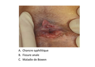 A. Chancre syphilitique
B. Fissure anale
C. Maladie de Bowen
 