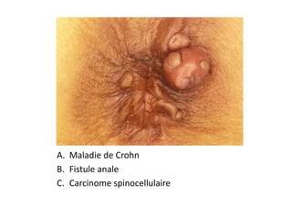A. Maladie de Crohn
B. Fistule anale
C. Carcinome spinocellulaire
 