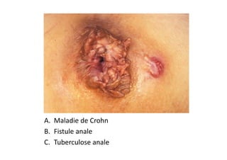 A. Maladie de Crohn
B. Fistule anale
C. Tuberculose anale
 
