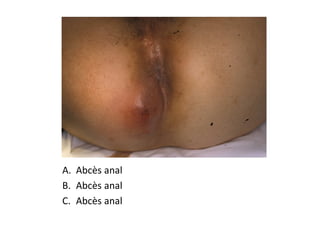A. Abcès anal
B. Abcès anal
C. Abcès anal
 