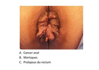 A. Cancer anal
B. Marisques
C. Prolapsus du rectum
 