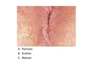 A. Psoriasis
B. Eczéma
C. Mycose
 
