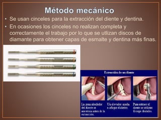 • Se usan cinceles para la extracción del diente y dentina.
• En ocasiones los cinceles no realizan completa y
correctamente el trabajo por lo que se utlizan discos de
diamante para obtener capas de esmalte y dentina más finas.
 