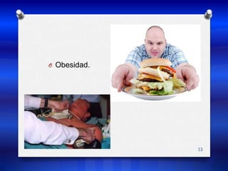 Obesidad.13