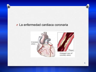 La enfermedad cardiaca coronaria6