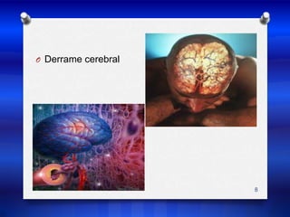 Derrame cerebral8