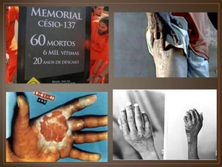 Acidentes Radiotivos e Nucleares