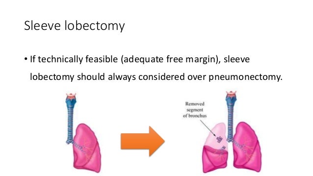 Surgical Approach to Non Small Cell Lung Cancer