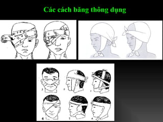 Các cách băng thông dụng   