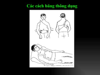 Các cách băng thông dụng   